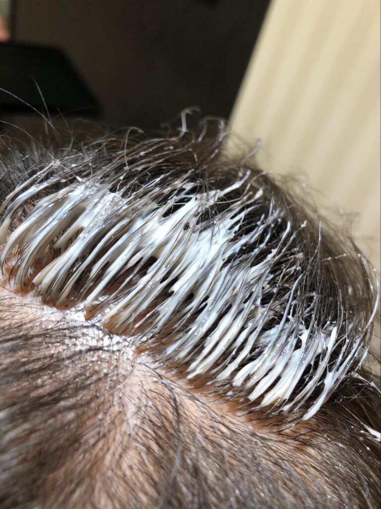 ゼロテクの施術のイメージ写真