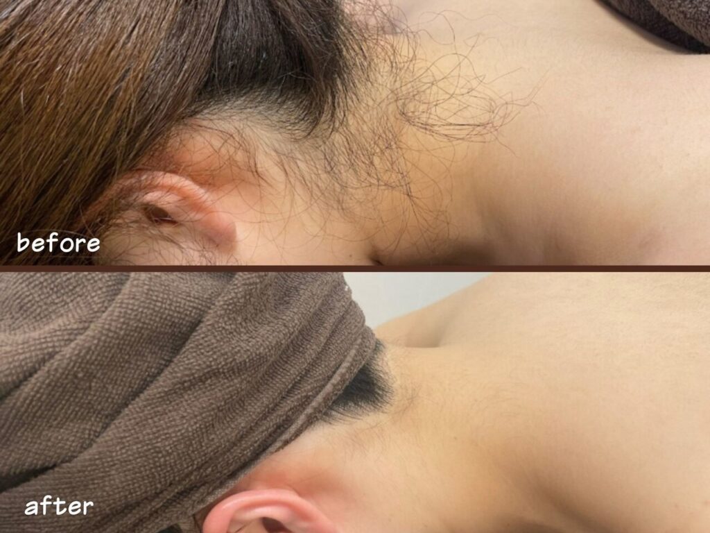 うなじ矯正のビフォーアフター画像