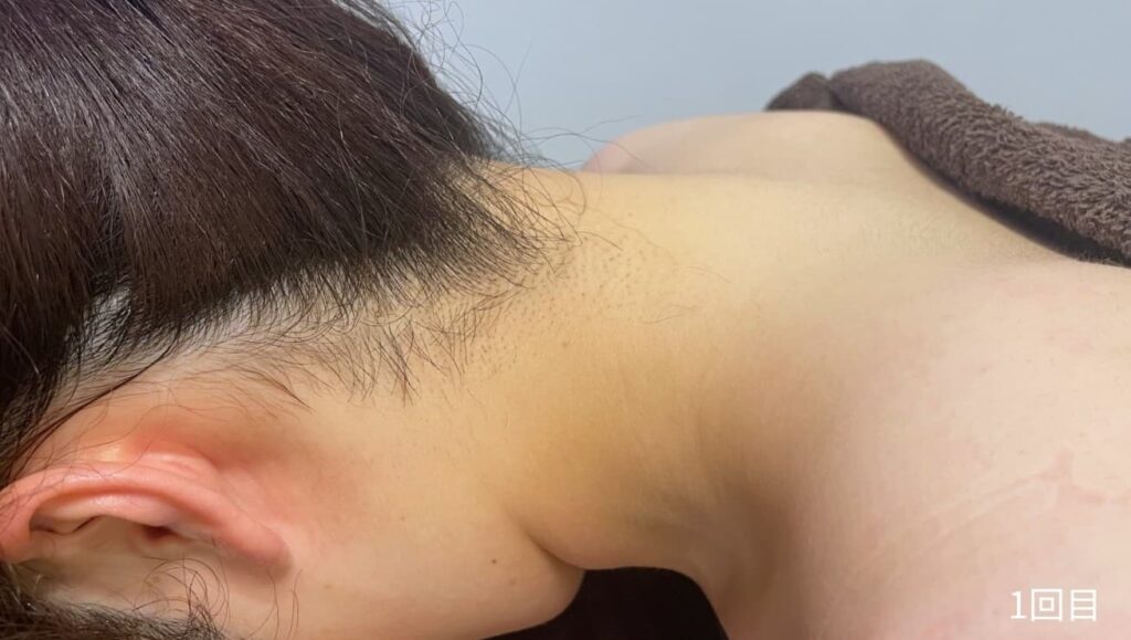 初回の施術後のうなじの画像
