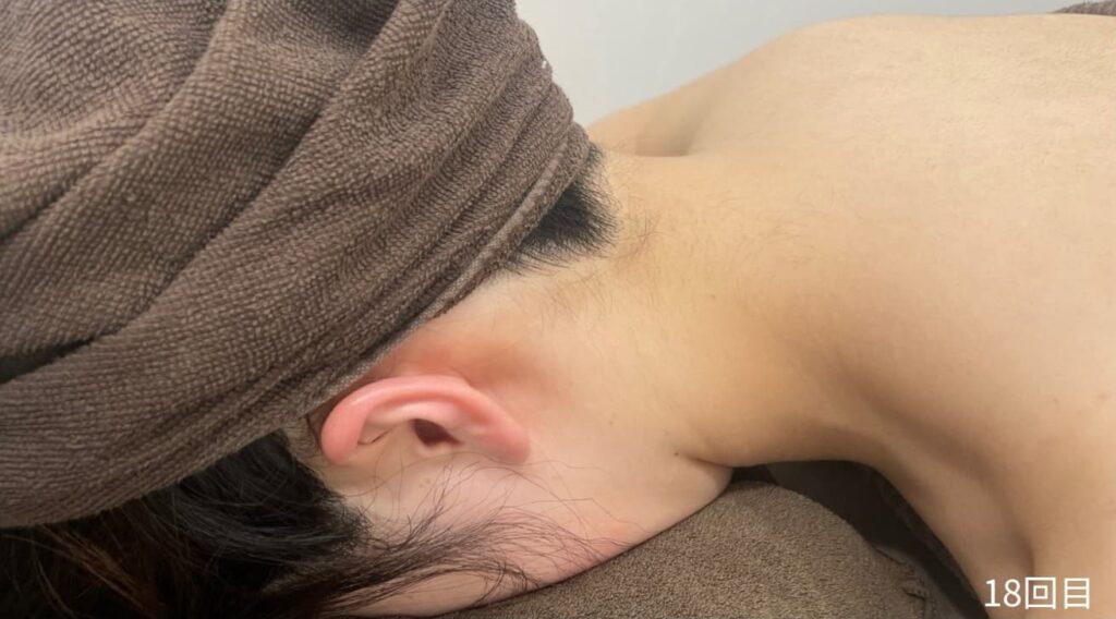 18回目の施術後のうなじの画像