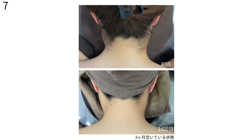 うなじ矯正のビフォーとアフターの画像